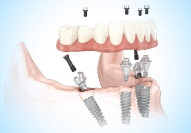 Система All-on-4 крепится на четыре опорных импланта