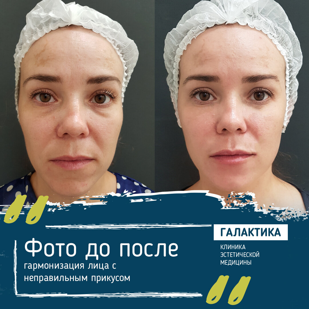 На фото: пациентка Елена до и после процедур по гармонизации лица с неправильным прикусом