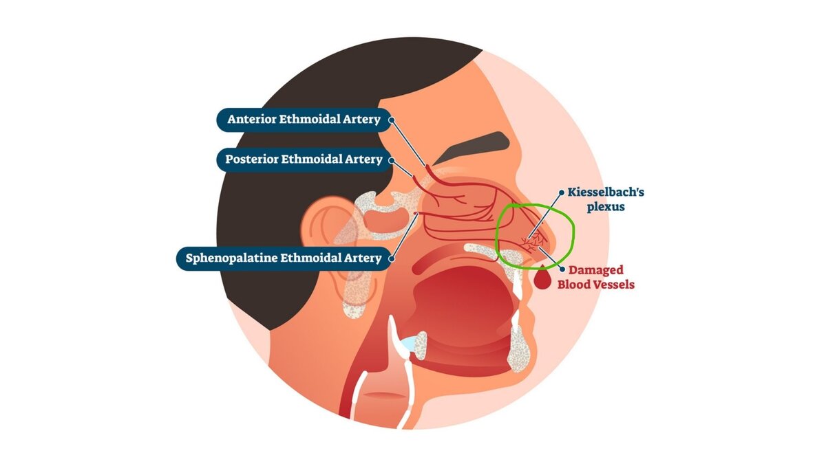 Сосудистое сплетение Киссельбаха (выделено зеленым цветом) - источник большинства носовых кровотечений