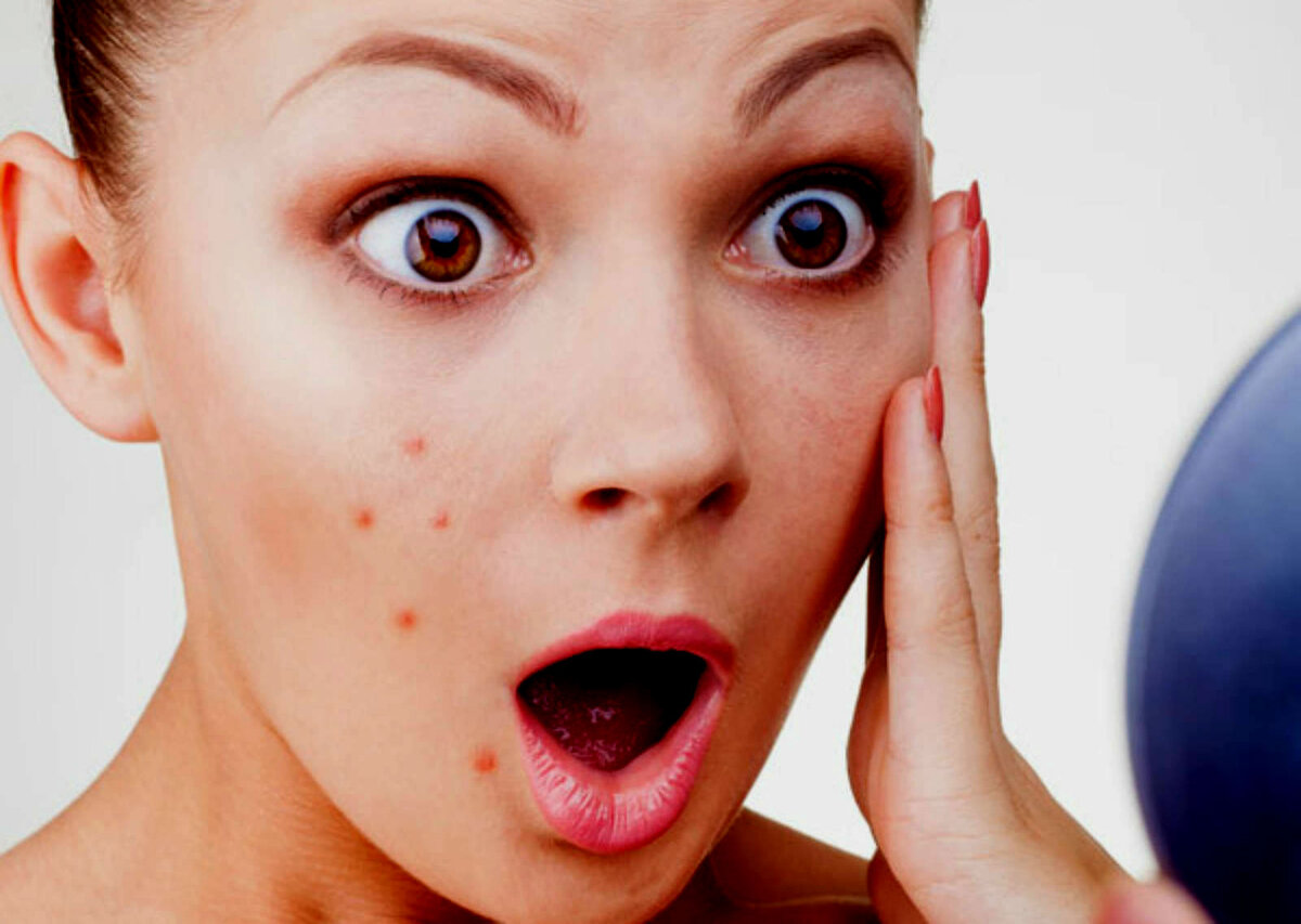                         Прыщи появляются всегда не вовремя