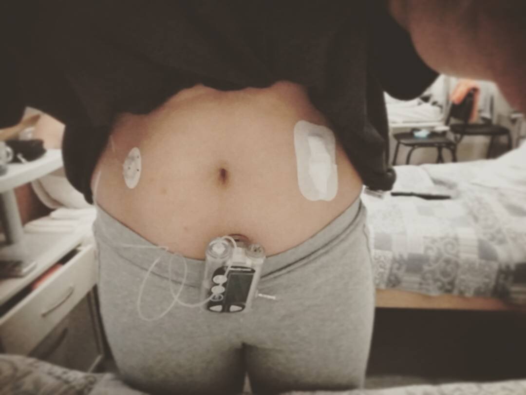 Круглое слева - это место крепления канюли, через которую поступает инсулин, к телу. 