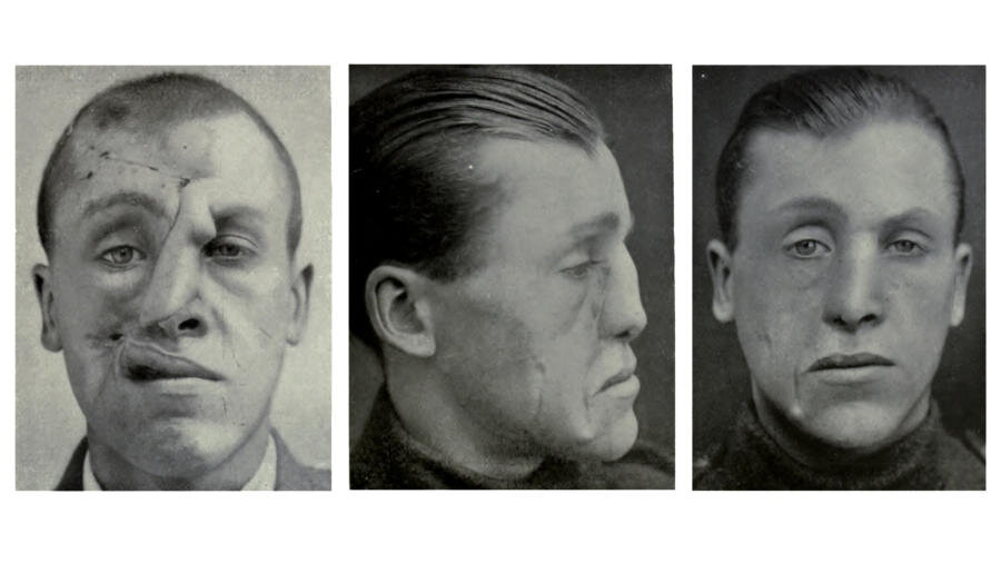 Раненый ветеран Первой Мировой Войны. Лечил Доктор Гарольд Гиллис, участвовавший в пластической хирургии 1920г .(Общественное Достояние)