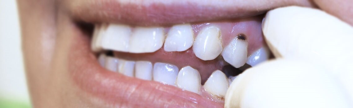 Кариес может быть у каждого, важно выявить и вылечить его на начальном этапе. Это сохранит вам как здоровье, так и средства.