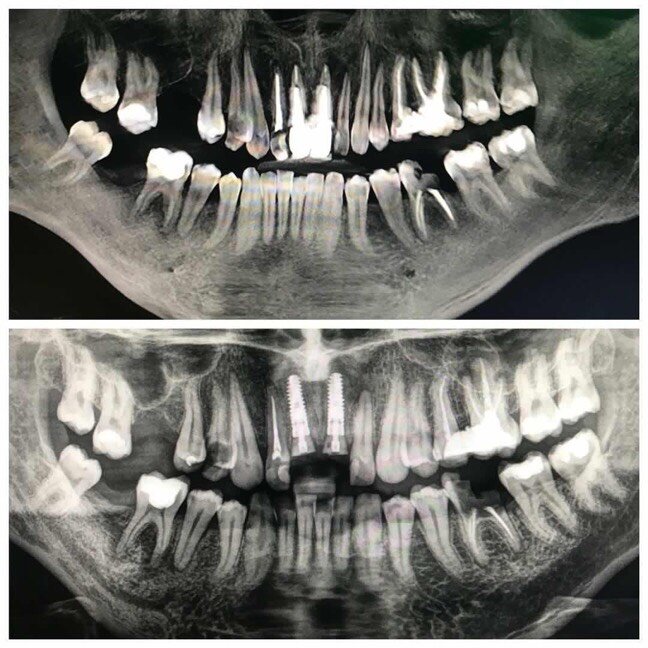 В данном случае, пациенту были изготовлены коронки на двух центральных зубах в сторонней клинике. Восстановление жевательных зубов было отложено. Результатом чего стала перегрузка. Коронки вместе с вкладками начали перманентно выпадать. В конечном итоге это привело к перелому как одного, так и второго корня. Исход один - удаление. в Подобном случае с одномоментной имплантацией. На очереди восстановление жевательной группы зубов и удаление 8ок. И да, кстати, пациент не ушел без зубов, были сделаны временные коронки, чтобы можно было улыбаться :)