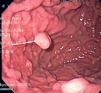  
          Полипы фундальных желёз желудка
     