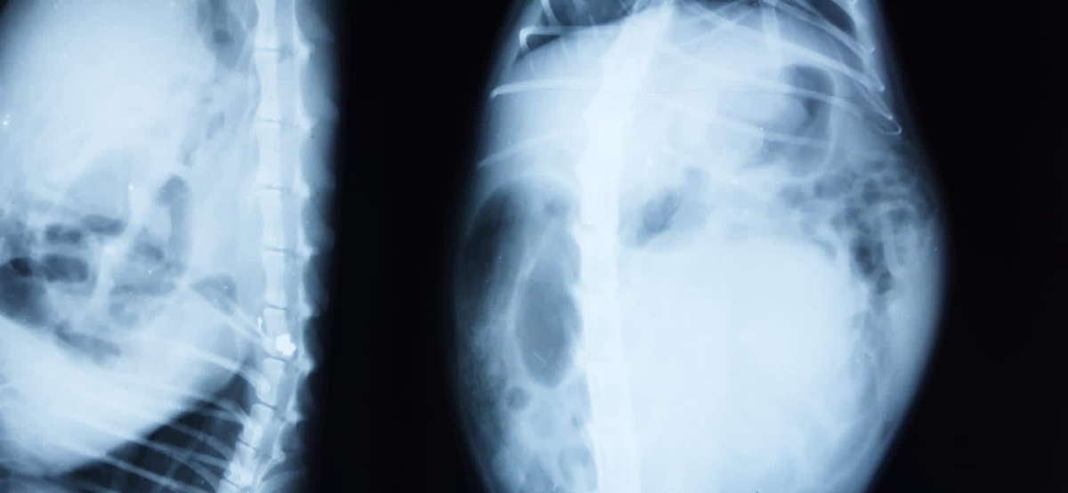 пуля в позвоночнике