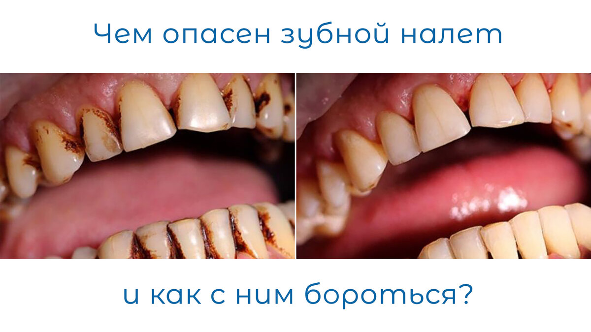 Случай из нашей практики: пациент 39 лет. Большой любитель кофе и чая. Много лет откладывал профилактику, стеснялся улыбаться. Пациенту провели профессиональную гигиеническую чистку зубов с использованием Airflow и глубоким фторированием и улыбка преобразилась!