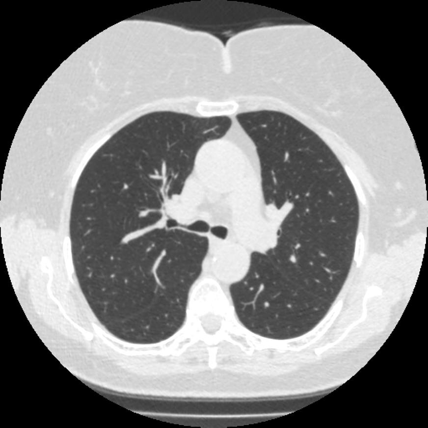 А такое качество при стандартном исследовании легких пациента.
