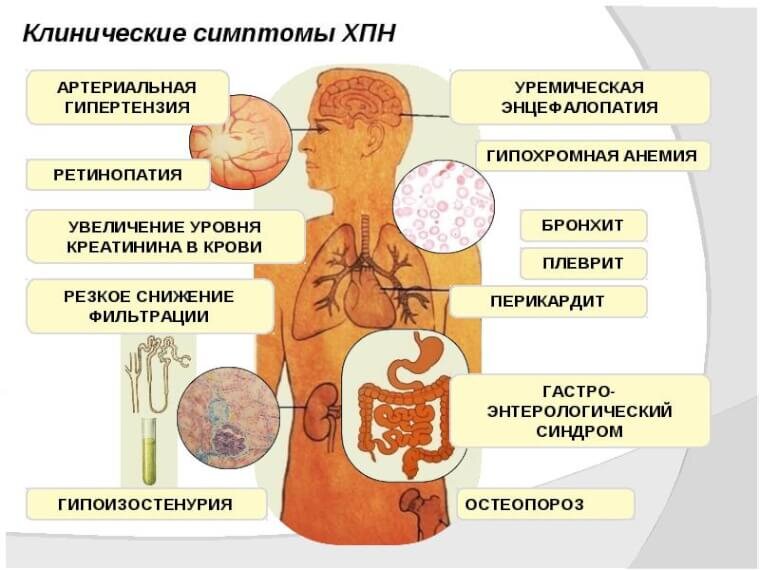 Почечная недостаточность как выглядит человек Хроническая почечная недостаточность: причины, симптоматика, лечение Пансионаты 