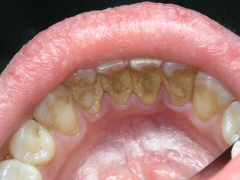  Зубной камень и налет во фронтальном участке