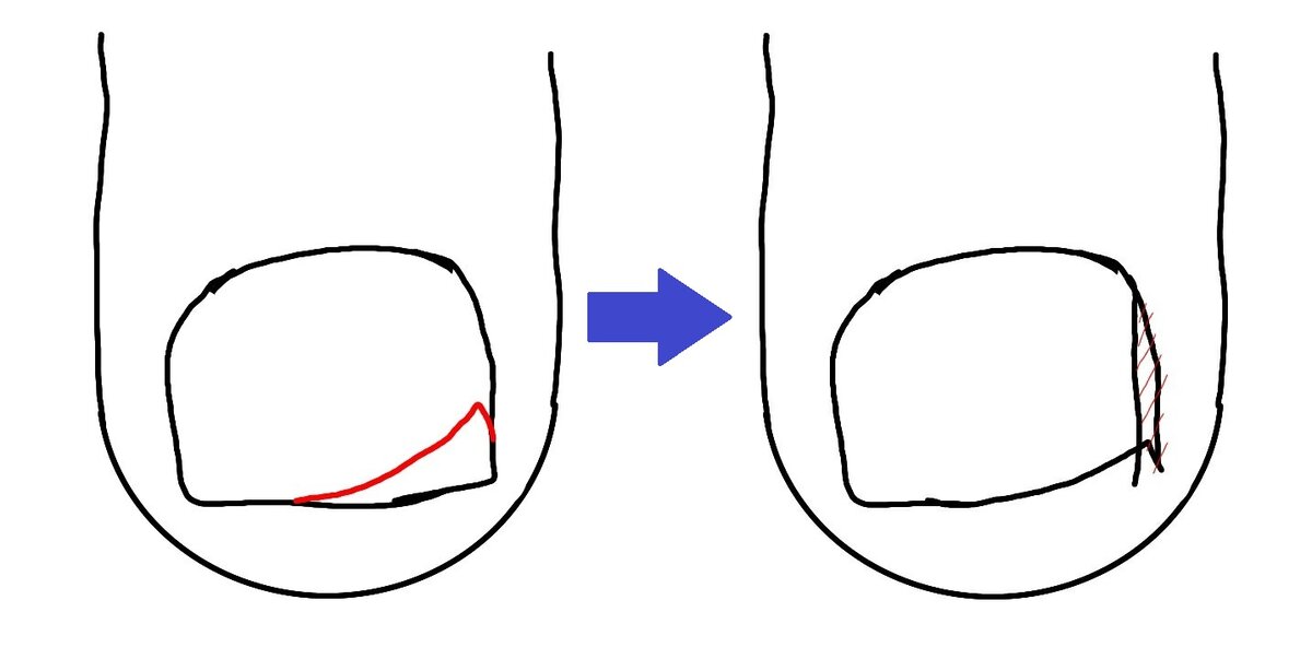 Как правильно подстричь вросший ноготь на ноге в домашних условиях