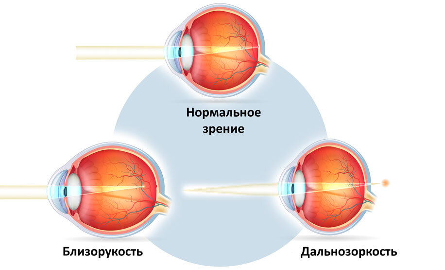 На схеме видно, что близорукий глаз "длиннее" нормального, а дальнозоркий  — короче