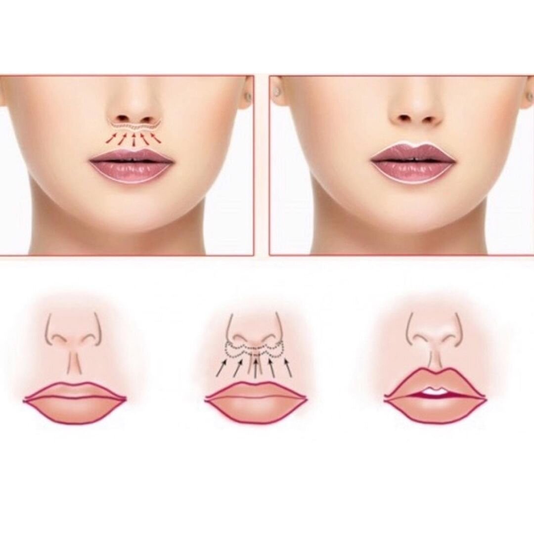 Между носом и ртом. Схема увеличения губ филлером. Фильтрума верхней губы.
