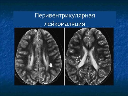 Стрелками указаны опухоли