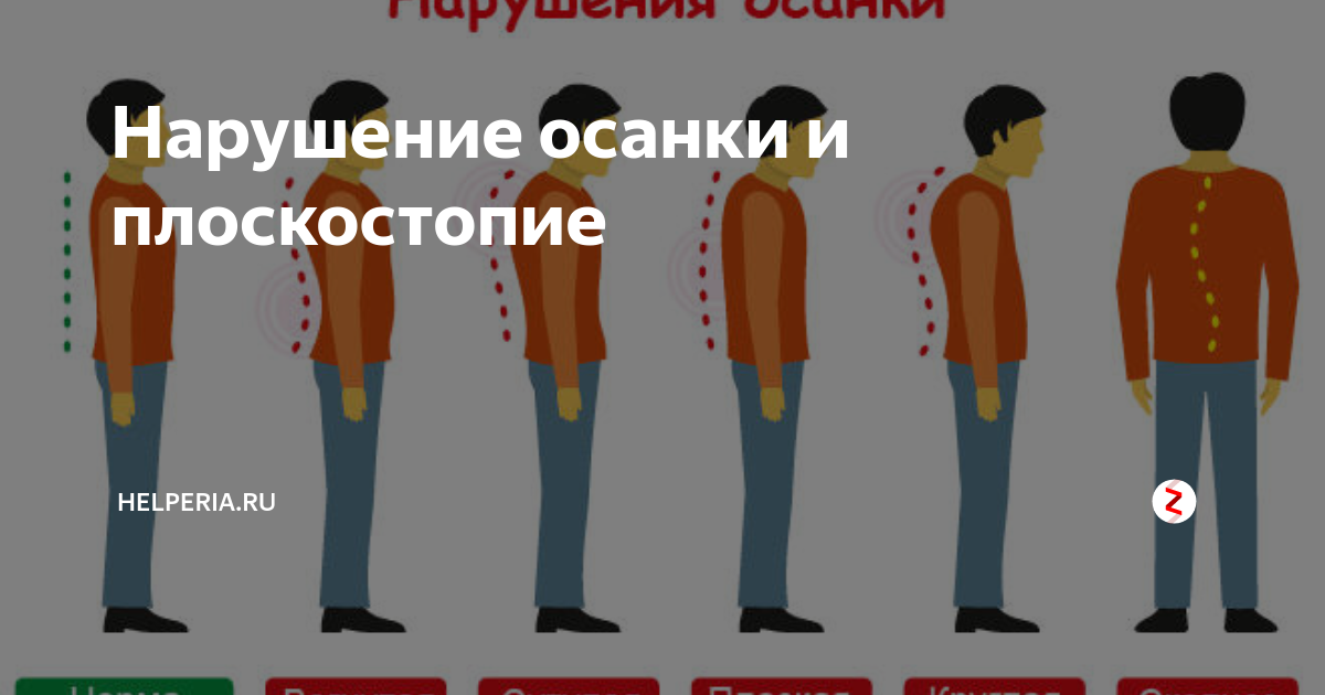 Нарушение осанки мкб 10. Нарушение осанки мкб 10