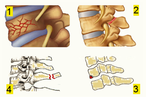  Компрессионный перелом (1), слом дужки (2), отрыв остистого отростка (3), каплевидный сгибательный излом (4)