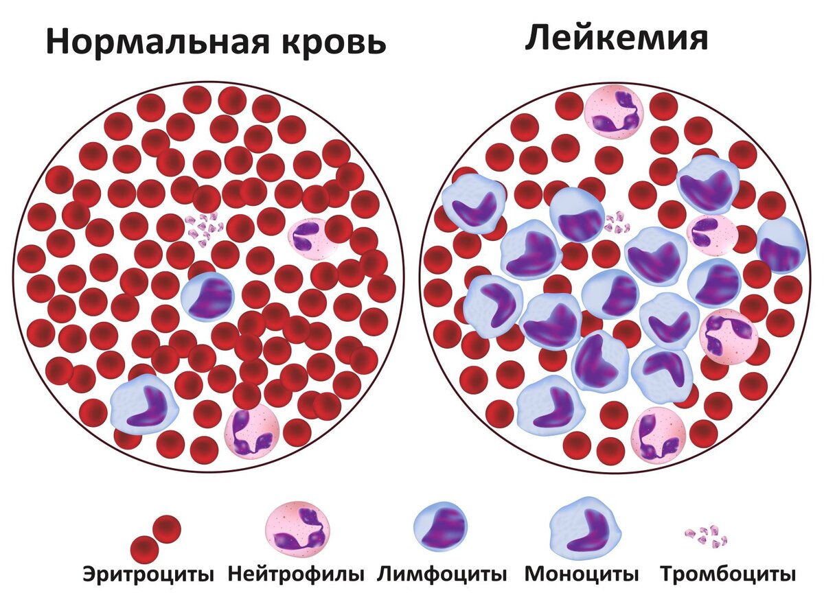 Разница между обычной кровью и человека с Лейкемией