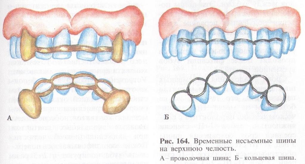 Временное и постоянное шинирование при пародонтите.