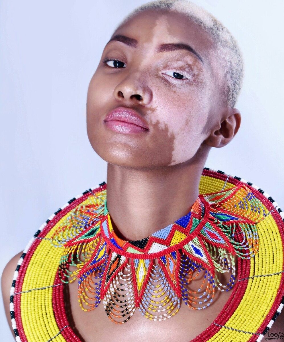 Заболевание "Витилиго". Фото: https://pin.it/qi3yn3kbhadw77