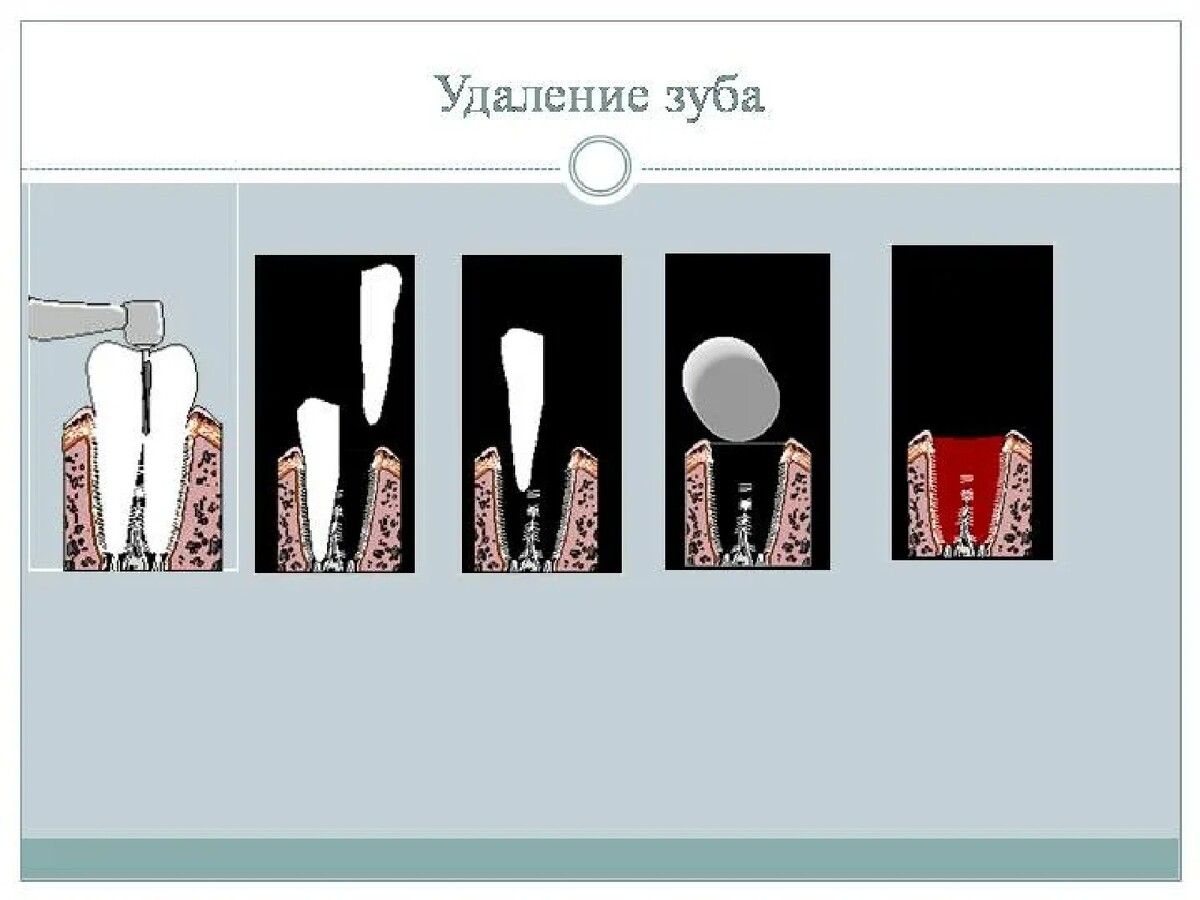 Удалить процесс удаленном. Схема выдергивания зуба. Технология вырывания зуба. Техника выдёргивание зубов.
