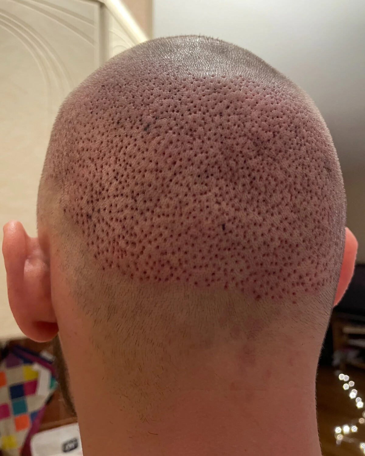 фото головы после пересадки волос