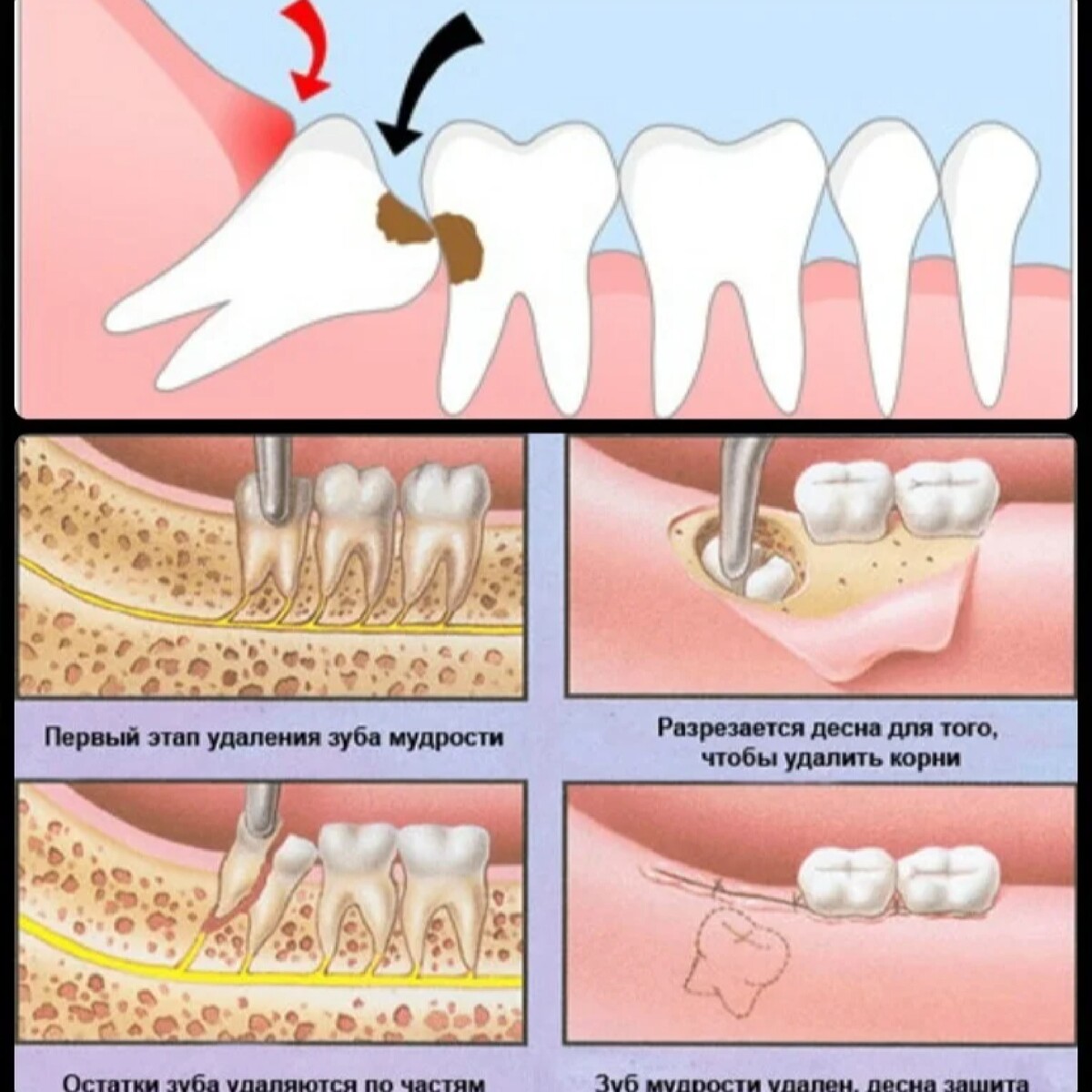 Зачем зубы мудрости. Удалили 8 зуб снизу мудрости. Как удаляют зуб мудрости.