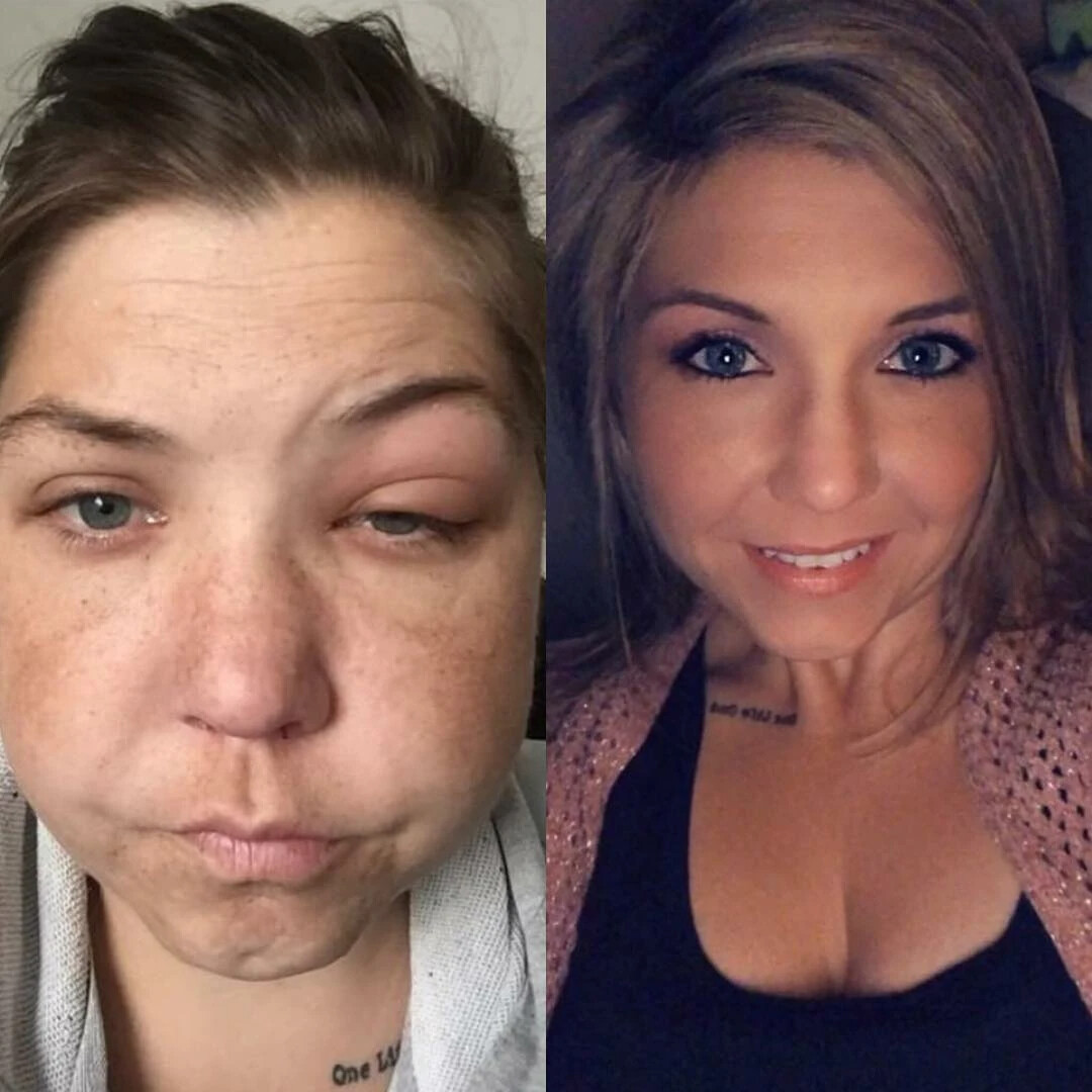 Пропитое лицо до и после